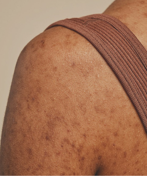 WHAT’S THE BEST WAY TO TREAT BODY ACNE?